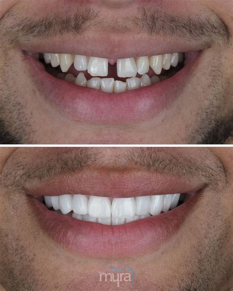 Teeth coverings Word Hike .